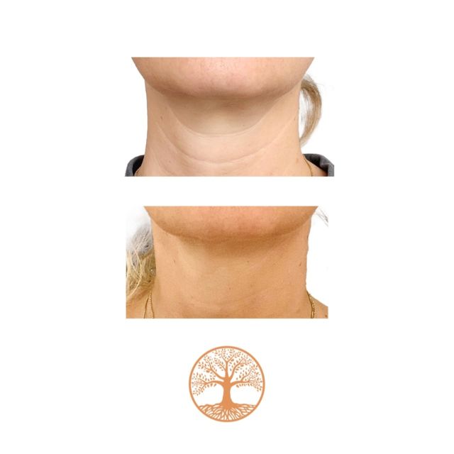 This is a beautiful result of Profhilo treatment for neck wrinkles. Targets lines, crepey skin, and loss of elasticity. It has become my favorite treatment option for this tricky area. ✨ Thanks to my lovely patient for sending this in and giving me permission to post! 🧡---#profhilo #aestheticmedicine #skintreatment #selfcare #aestheticdoctor #munich #muenchen